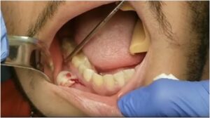 ما هو الخراج ولماذا يحدث؟ ما هو مفيد لخراج الأسنان؟ الأعراض والعلاج