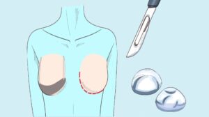 كيف تجرى عملية تكبير الثدي ؟ طرق تكبير الثدي