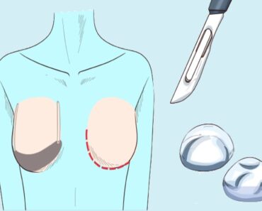 كيف تجرى عملية تكبير الثدي ؟ طرق تكبير الصدر