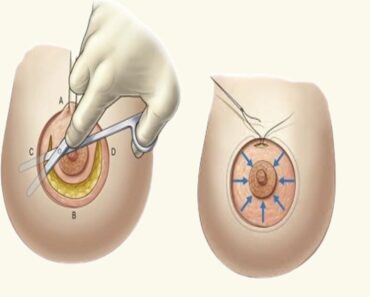 كيف يتم إجراء جراحة تصغير الثدي؟ طرق تصغير الثدي
