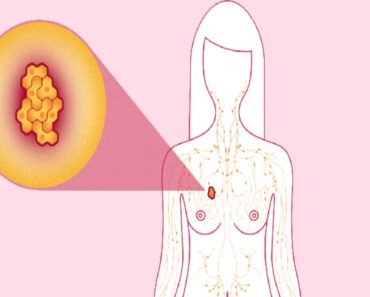 ما الذي يسبب سرطان الثدي ؟ الأعراض والعلاج والفحص اليدوي