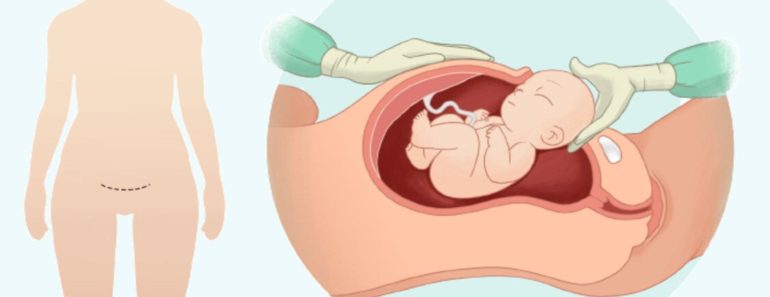 الولادة القيصرية وأبرز الاسئلة حول العملية القيصرية