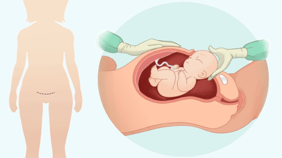 الولادة القيصرية وأبرز الاسئلة حول العملية القيصرية