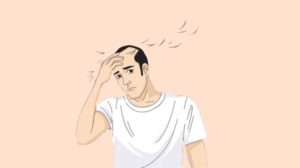ما هو تساقط الشعر الكربي: الأسباب والأعراض والعلاج