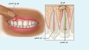 خراج الاسنان: الاسباب والاعراض والعلاج