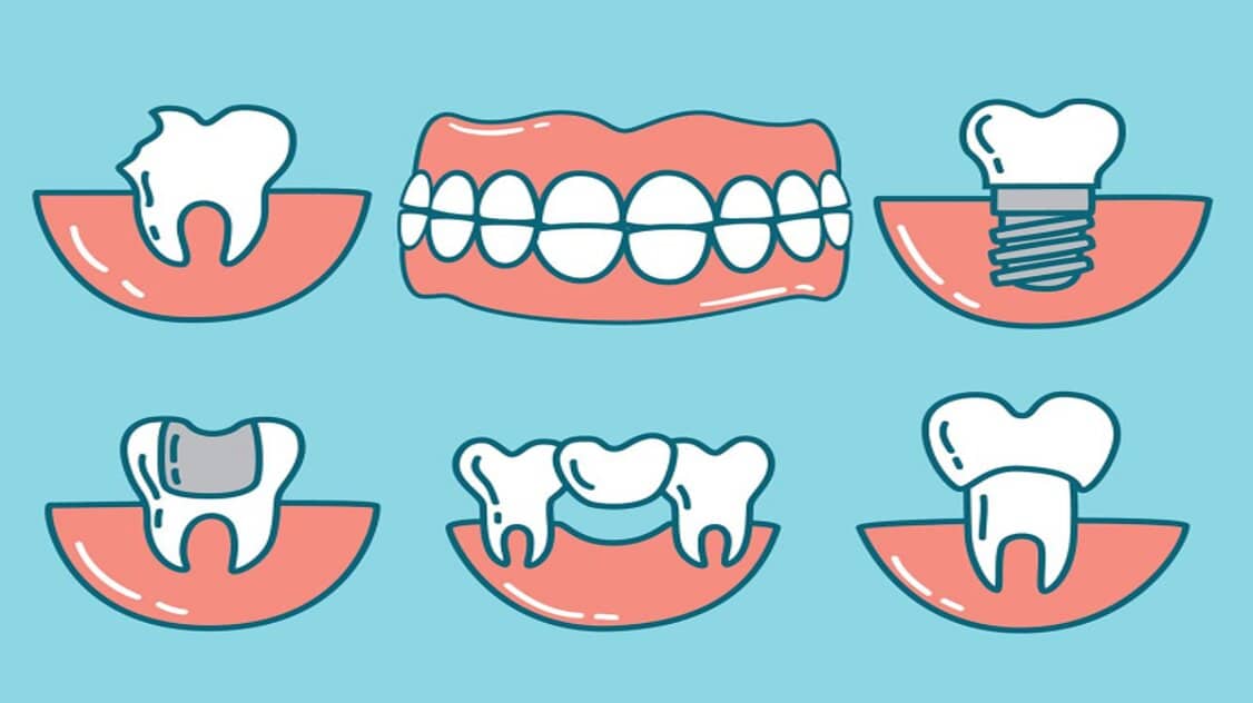 عملية زراعة الاسنان هل تدوم مدى الحياة؟