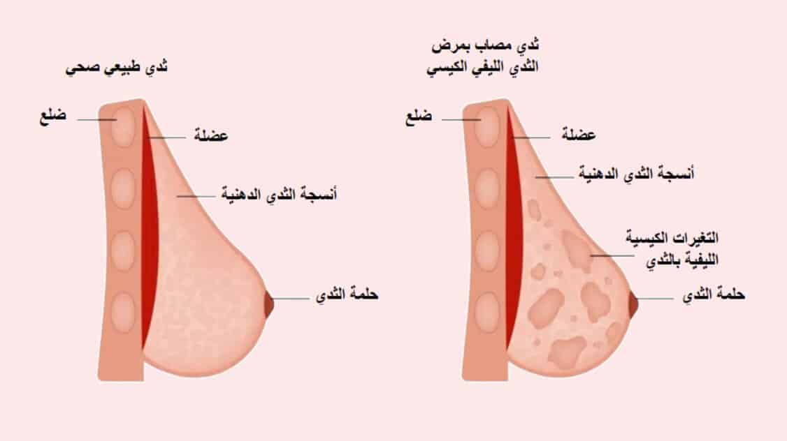 أعراض أكياس الثدي الحميدة هل تختفي من تلقاء نفسها؟