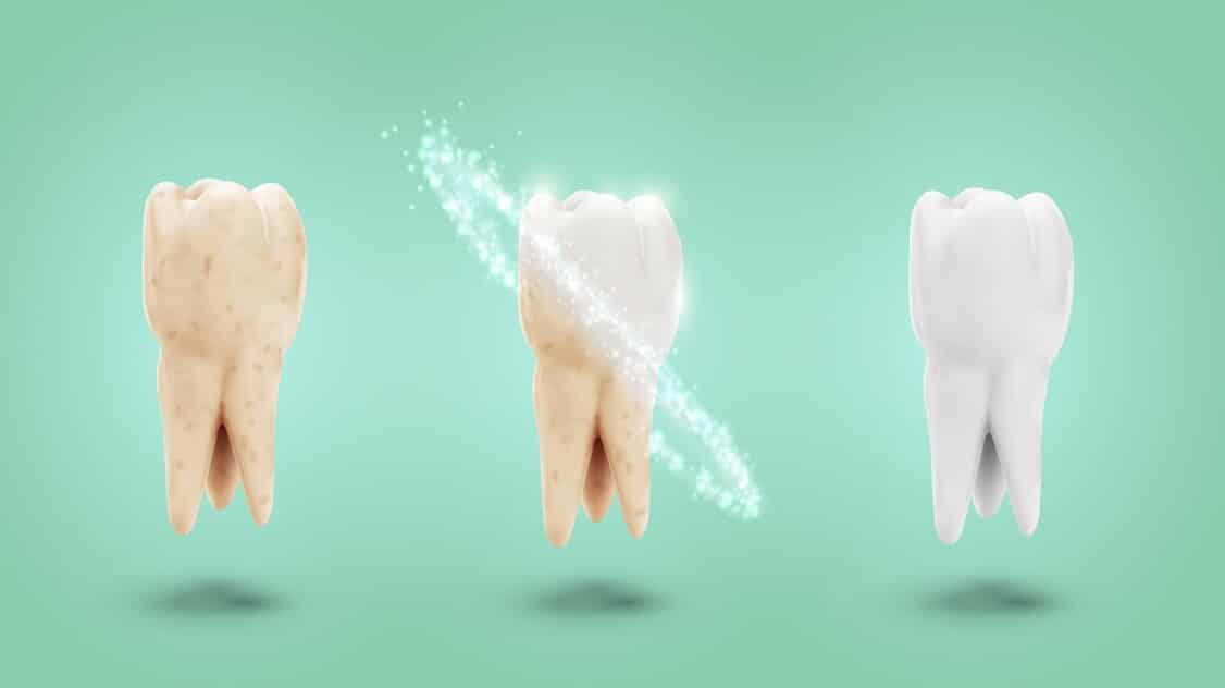 ما هي فوائد واضرار بودرة تبييض الاسنان؟